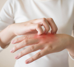 אקזמה: מפריכים את המיתוסים-תמונה